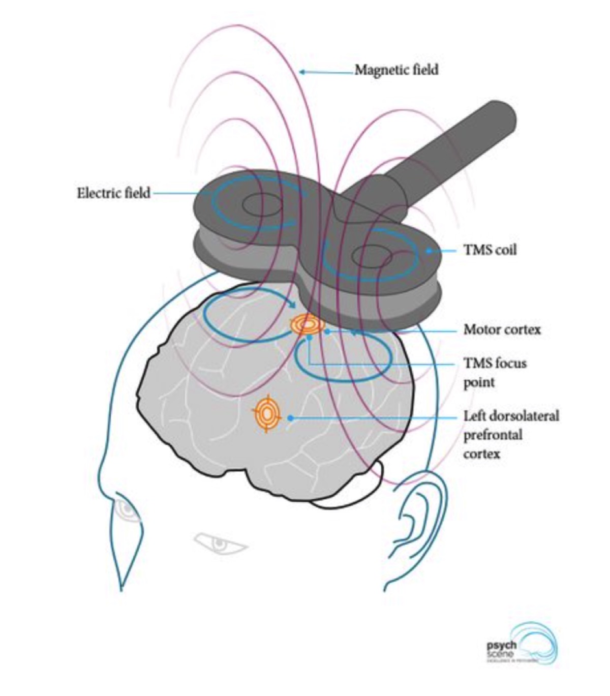 Ilustrație articol blog TeleMind, România: TMS accelerat și iTBS pentru depresie rezistentă: ce știm în 2026. Ghid medical educativ pentru pacienți; revizuire conținut Dr. Lavinia Dobrescu, medic specialist psihiatru și psihoterapeut.